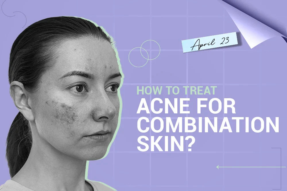 How to Treat Acne for Combination Skin? How to Treat Acne for Combination Skin?
