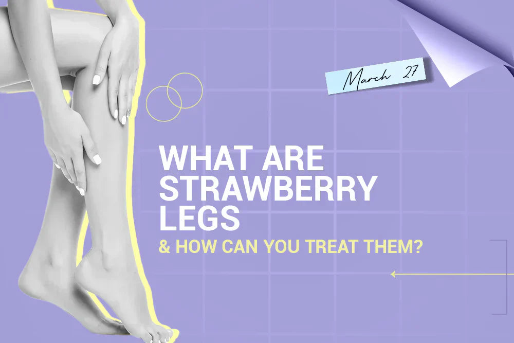 What Are Strawberry Legs and How Can You Treat Them? What Are Strawberry Legs and How Can You Treat Them?