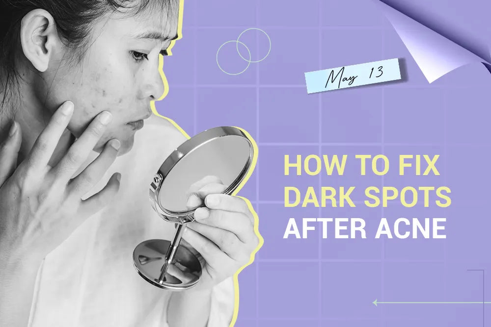 How to Fix Dark Spots After Acne How to Fix Dark Spots After Acne