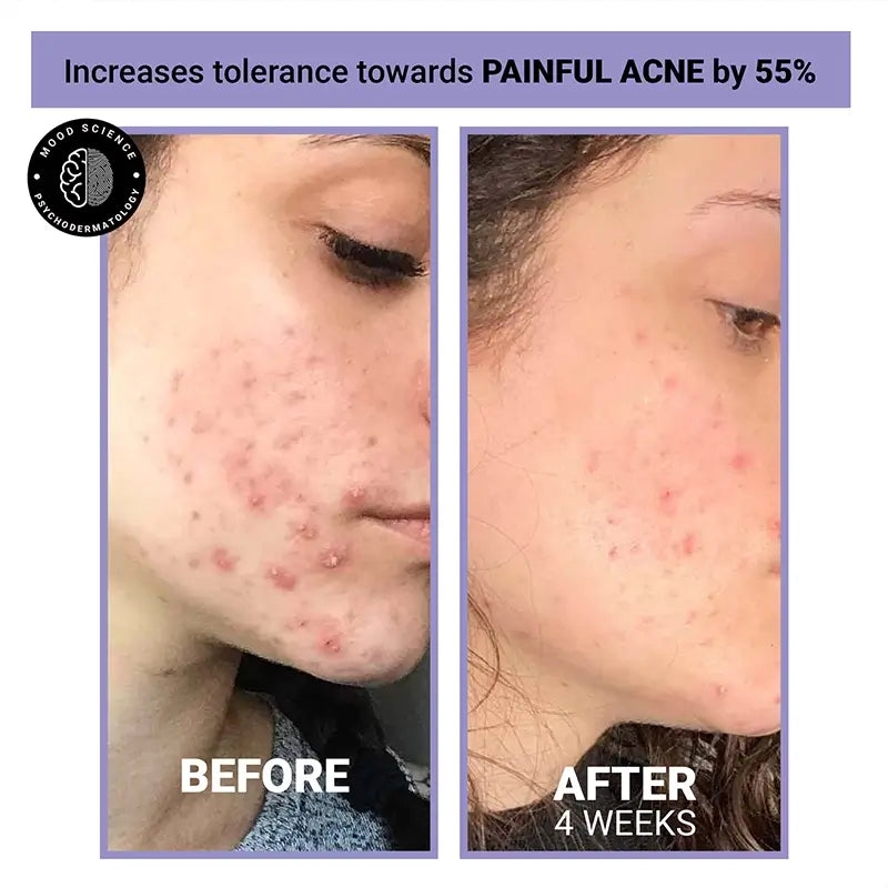 Product media face toner for acne