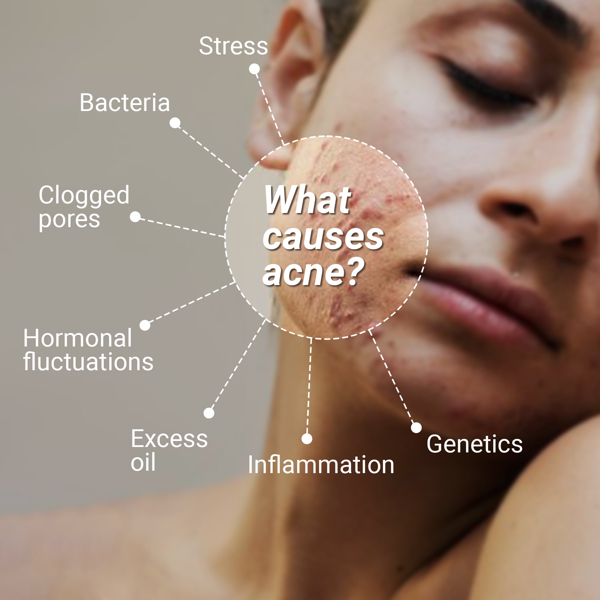 Product media Anti-Acne Advanced Detox Kit