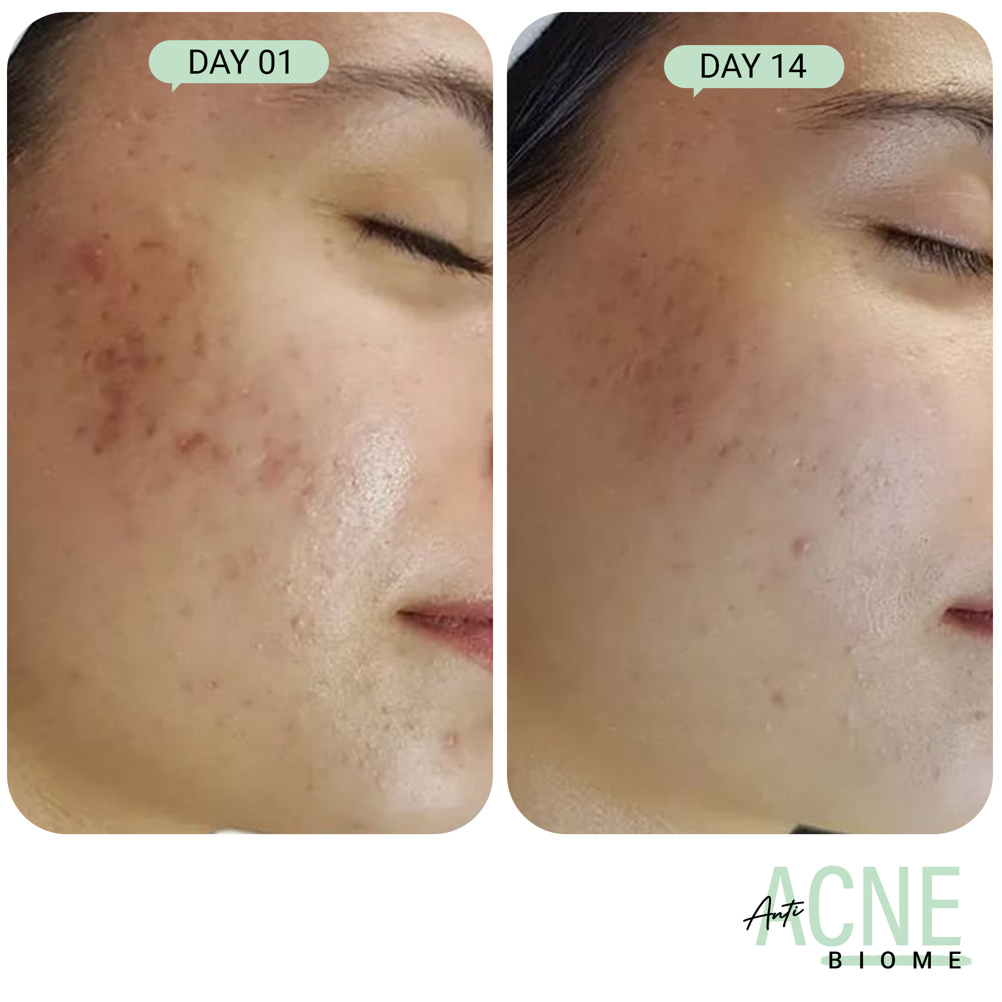 Product media Acne Control Combo