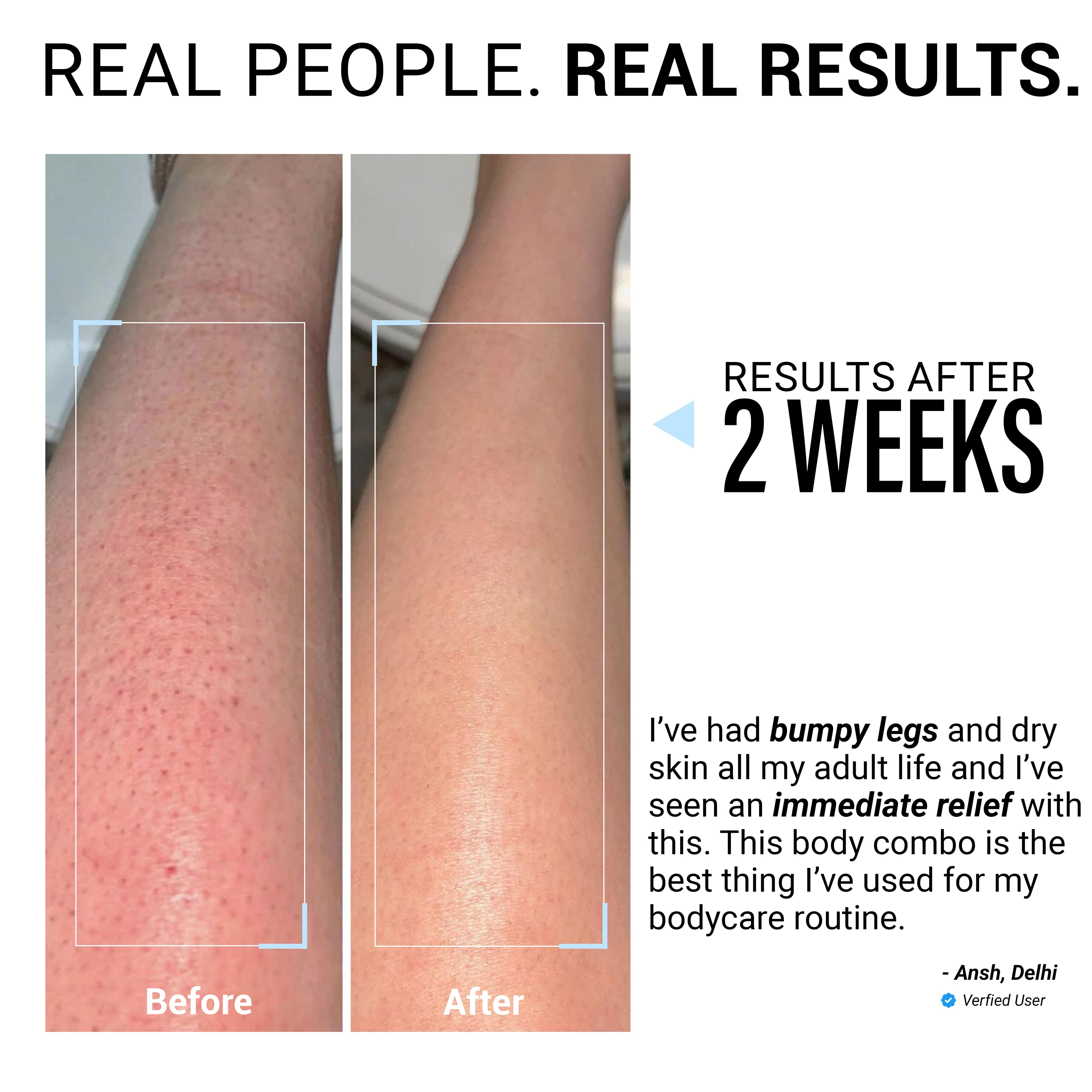 Product media 48hr Dry Skin Relief Body Wash & Body Lotion Travel Combo with Urea Treatment