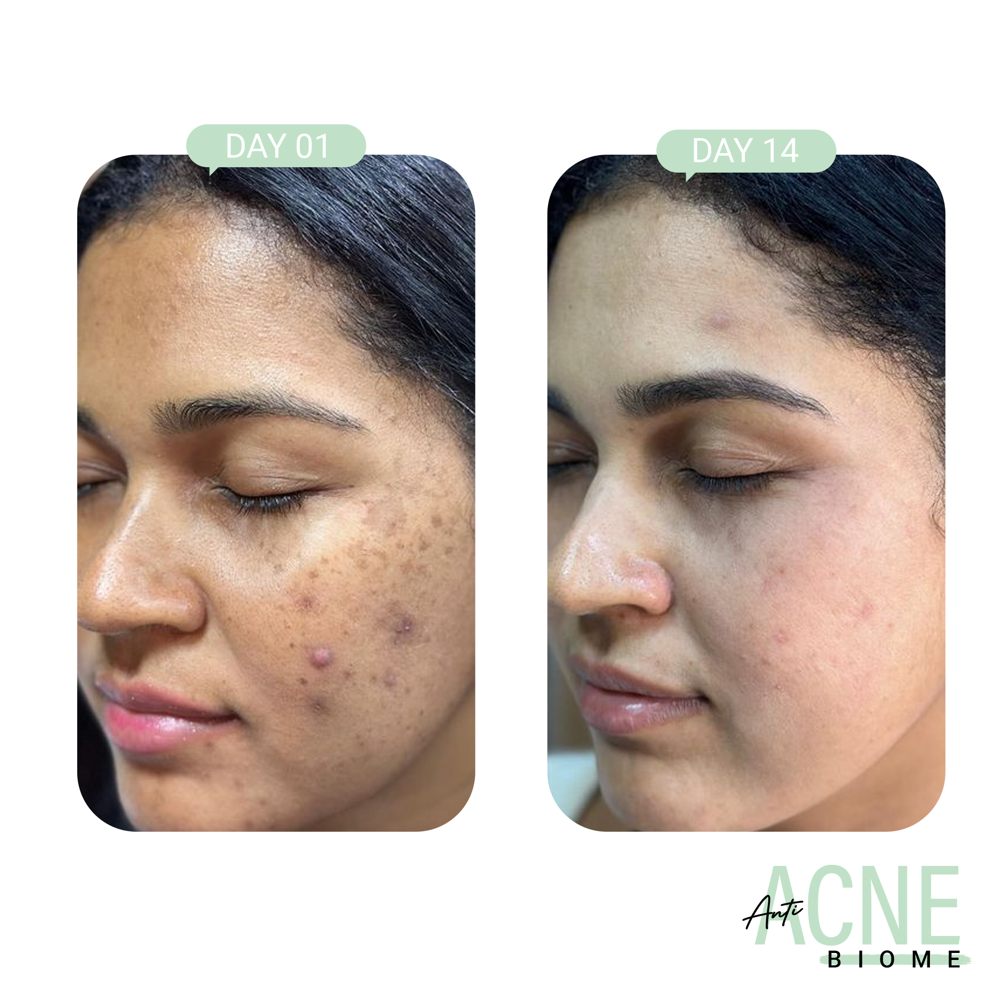 Product media Anti-Acne Complete Regime