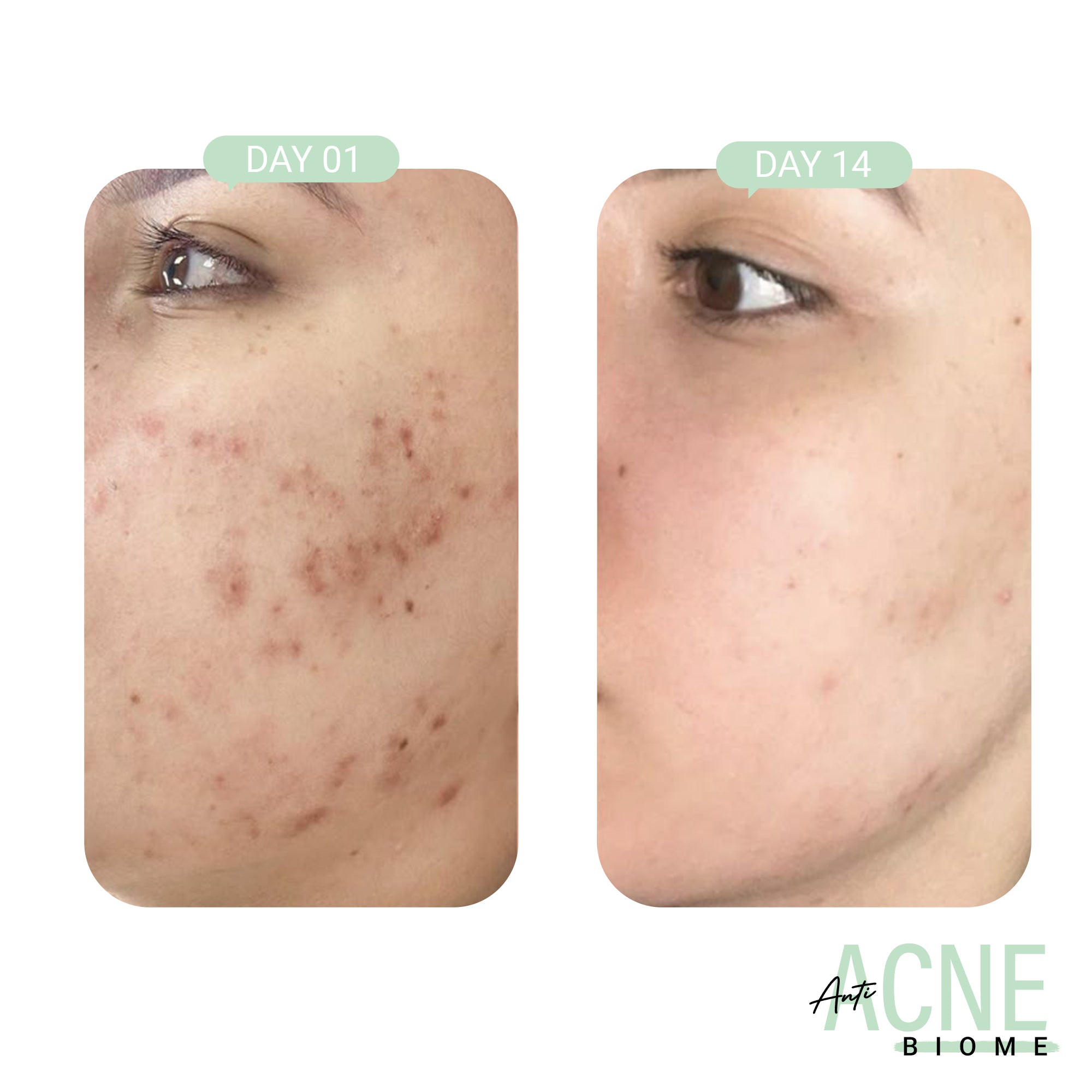 Product media Anti-Acne Duo