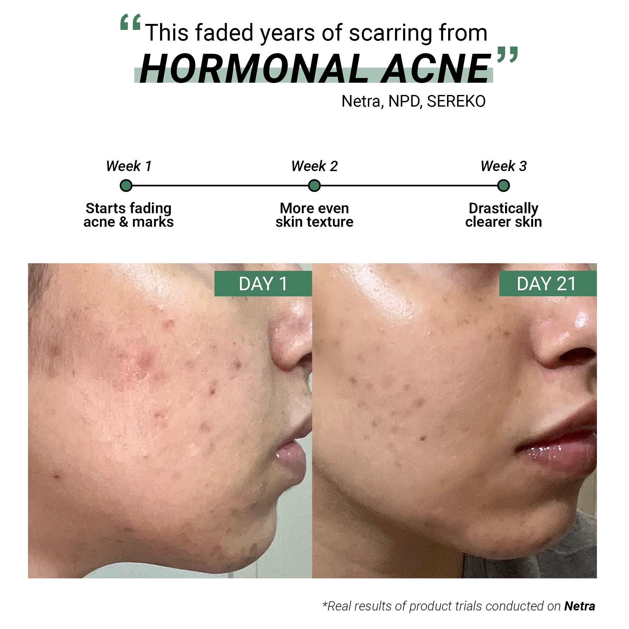 Product media Anti-Acne Advanced Detox Kit