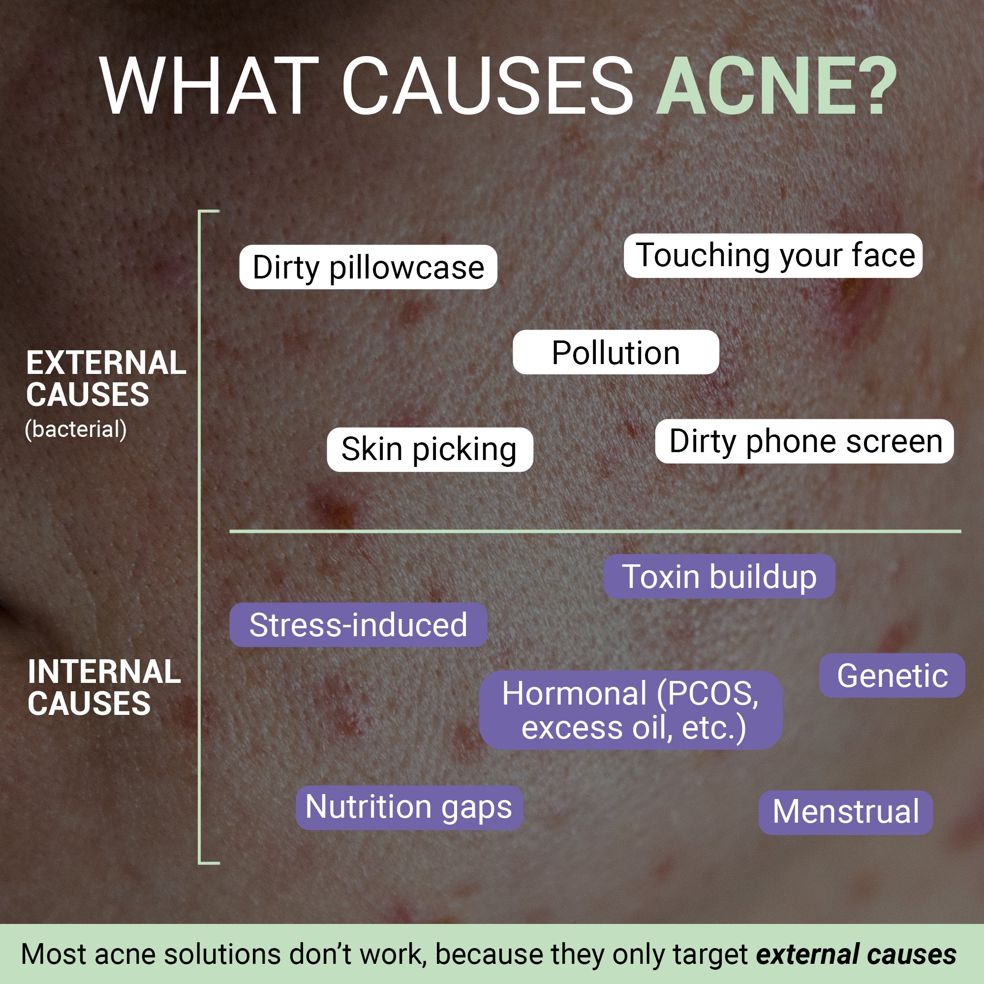 Product media Anti-Acne Advanced Detox Kit