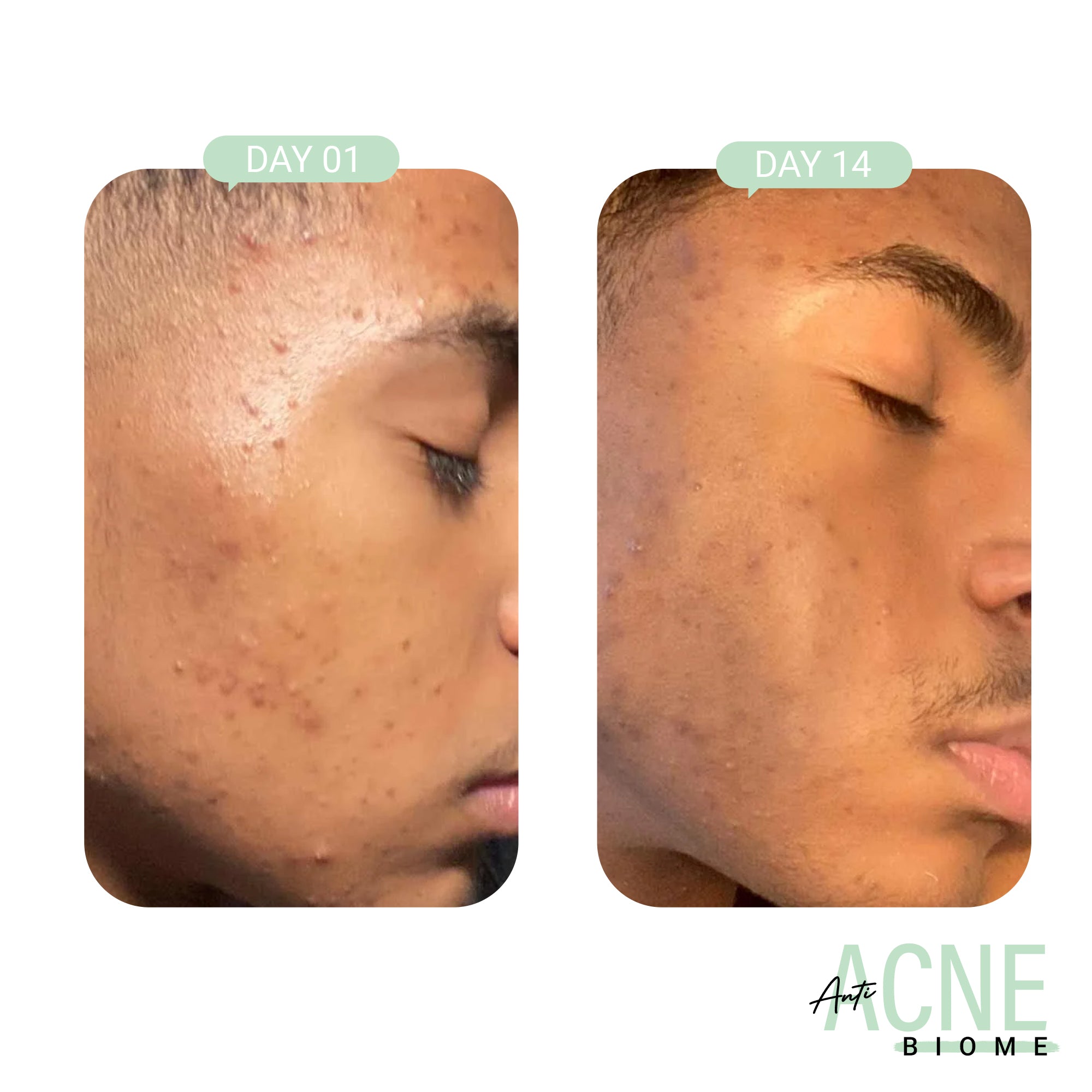 Product media Anti-Acne Advanced Detox Kit