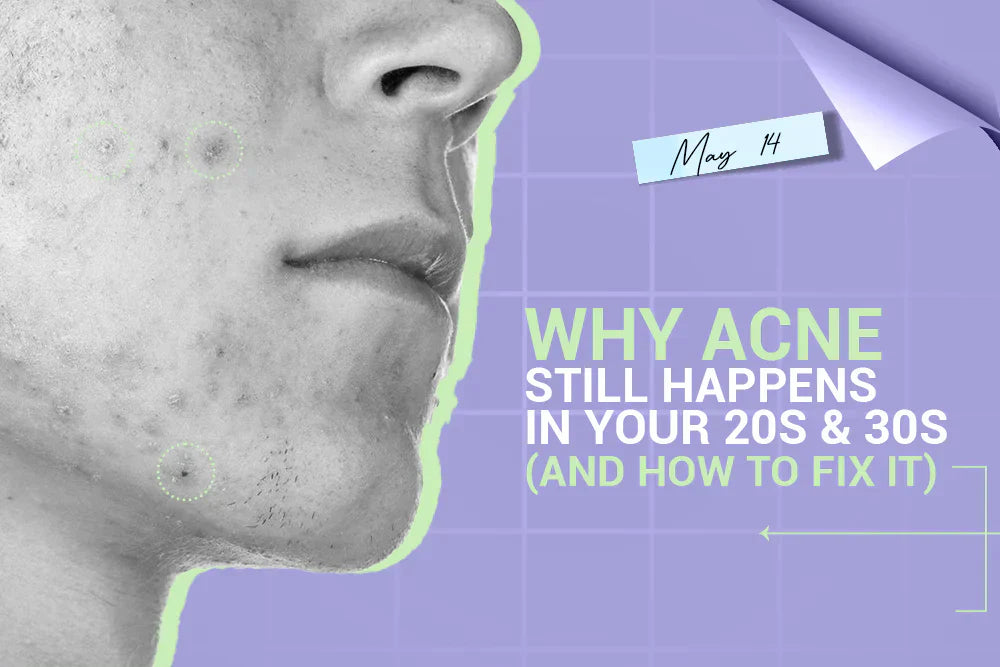 Why Acne Still Happens in Your 20s & 30s (And How to Fix It)