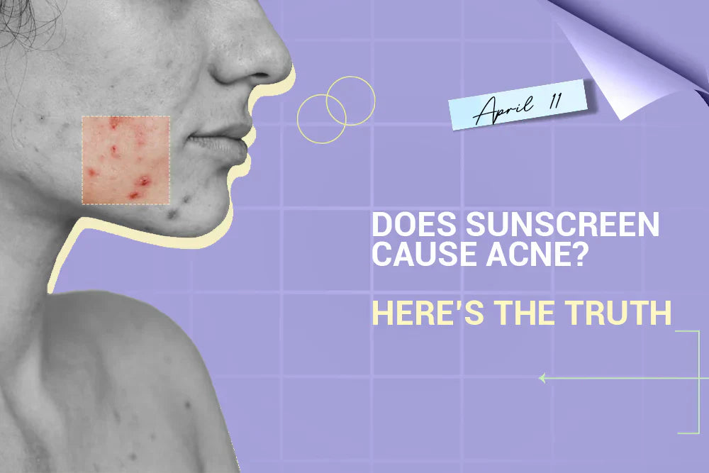 Does Sunscreen Cause Acne? Here’s the Truth