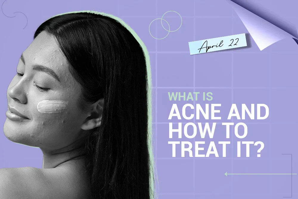Acne and Their Treatment