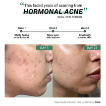 Anti-Acne Advanced Detox Kit