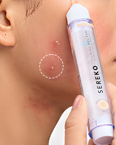 Active Acne