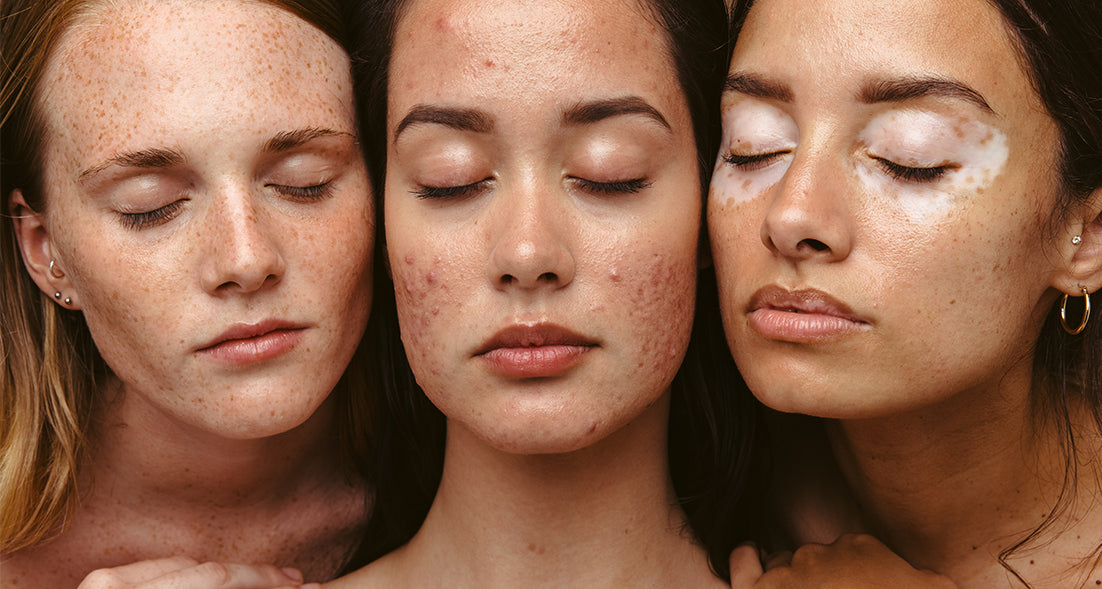 The Link Between Hormonal Changes and Adult Acne